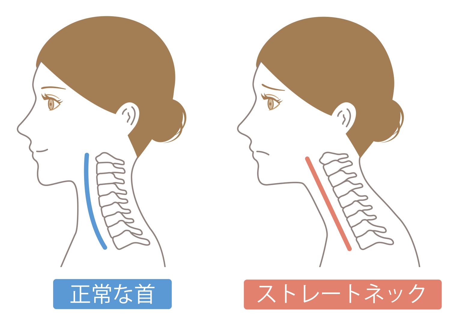 正常な首・ストレートネック