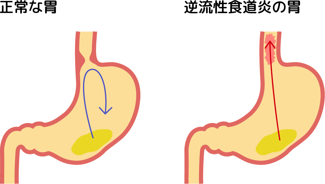 正常な胃・逆流性食道炎の胃