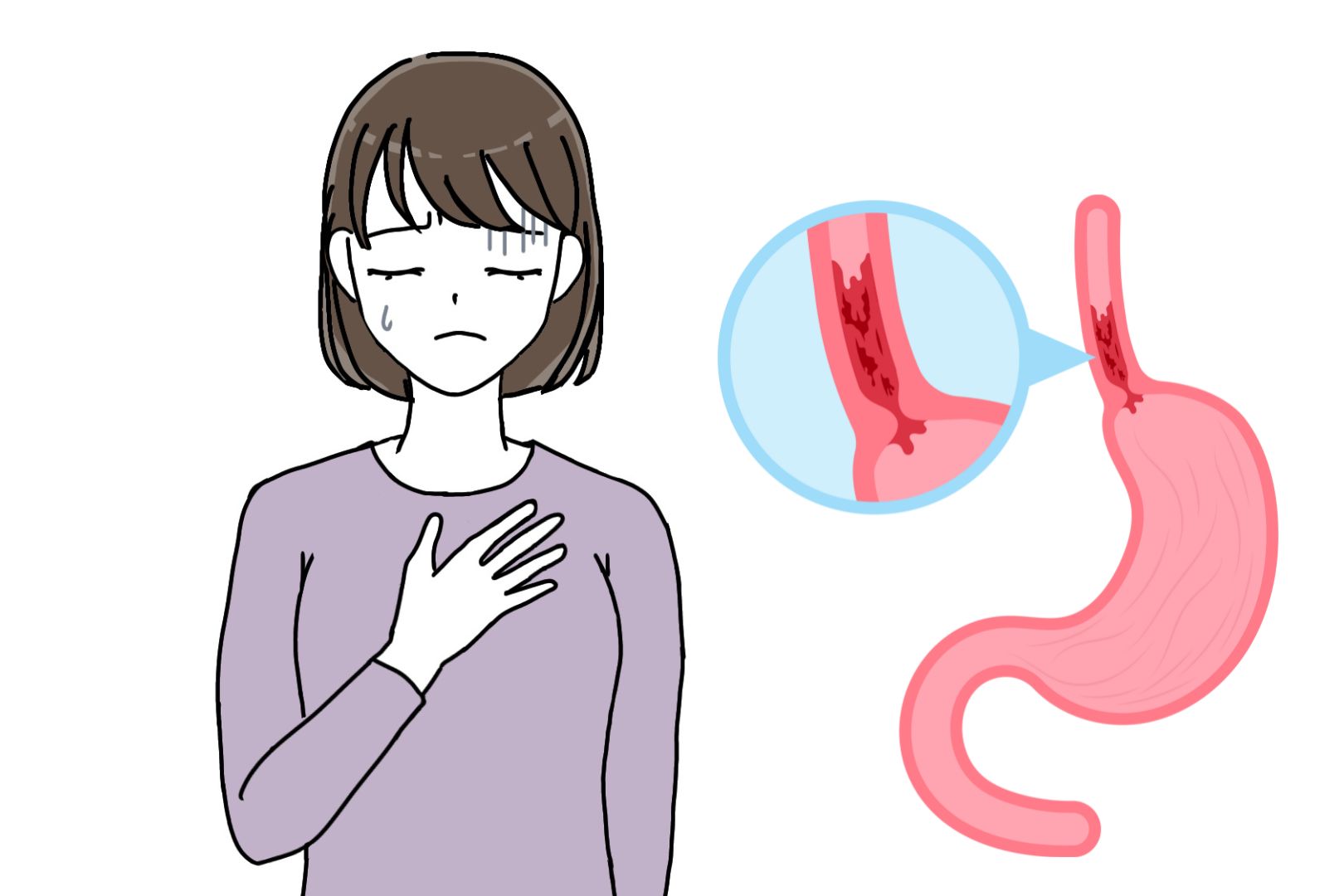逆流性食道炎で悩む女性
