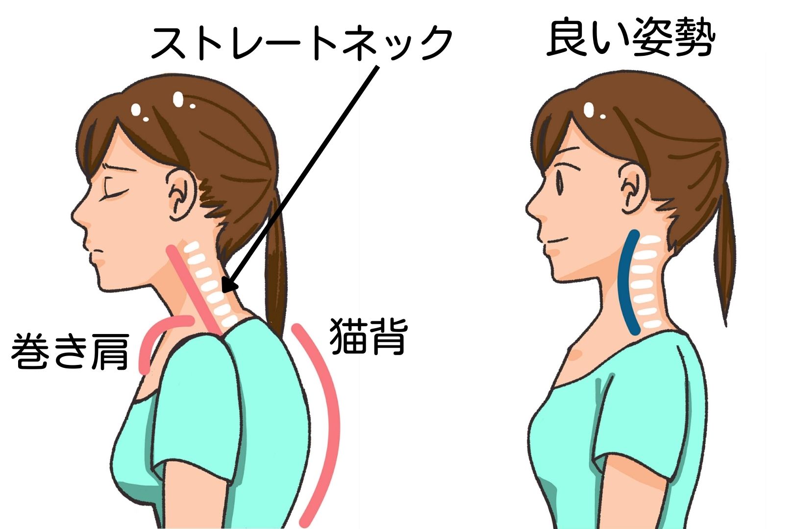 ストレートネック・猫背・巻き肩