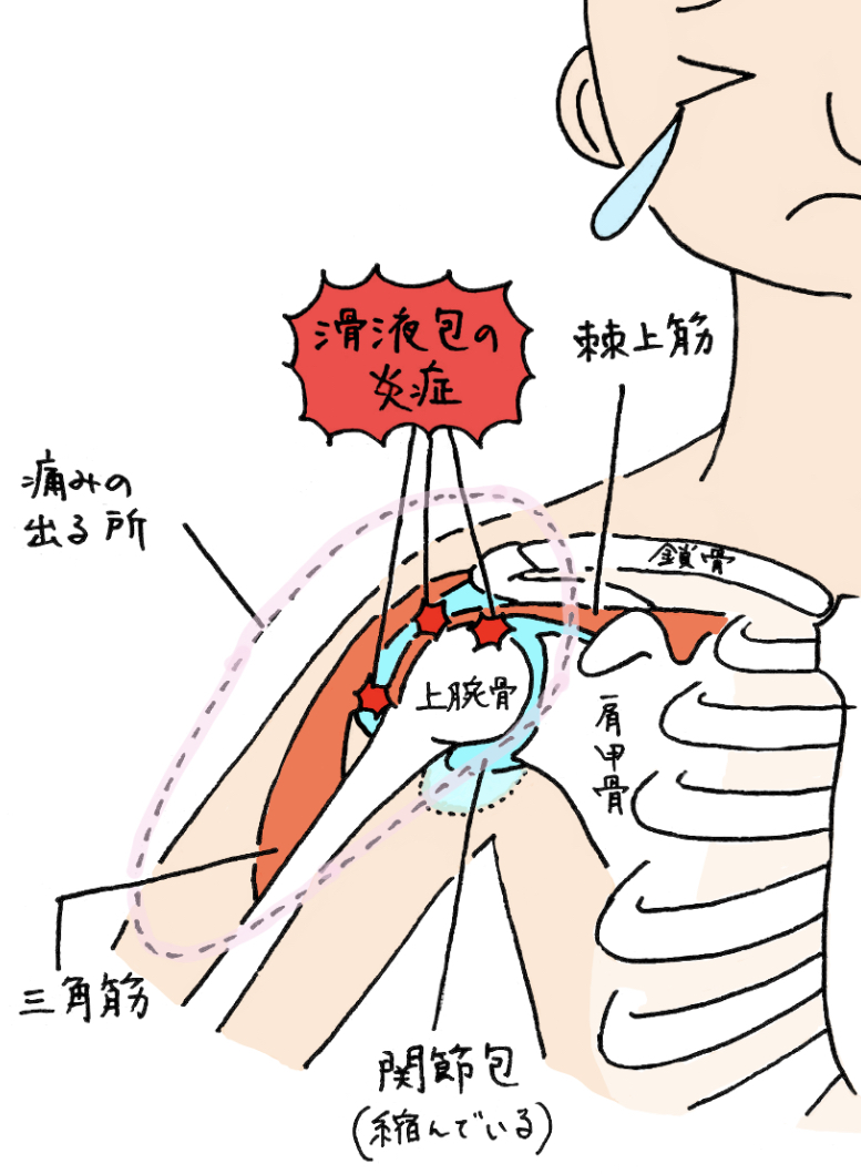 四十肩・五十肩の原因。滑液包の炎症。